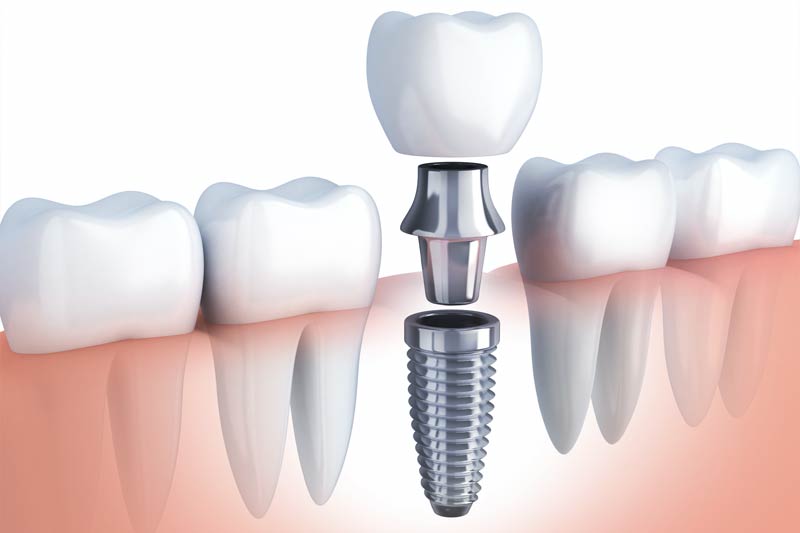 Implants Dentist in Morgan Hill